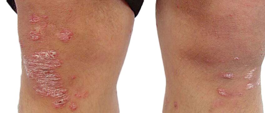 Psoriasis is an unpleasant skin disease requiring treatment with Keraderm cream