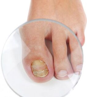 Nail mushroom