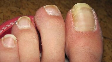 How the fungus on the nails manifests itself