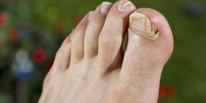 fungus on the nail of the big toe