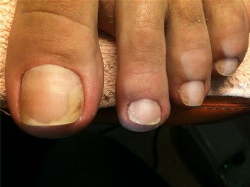fungal infection of the nail plate