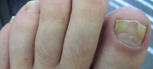 symptoms of fungus on the nail and its treatment with vinegar