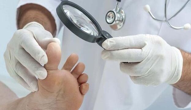Fungus diagnosis