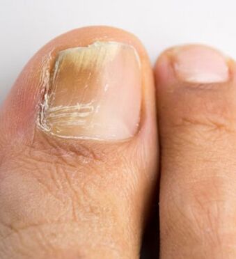 Nail fungus on the big toe, which occurs against the background of weak immunity