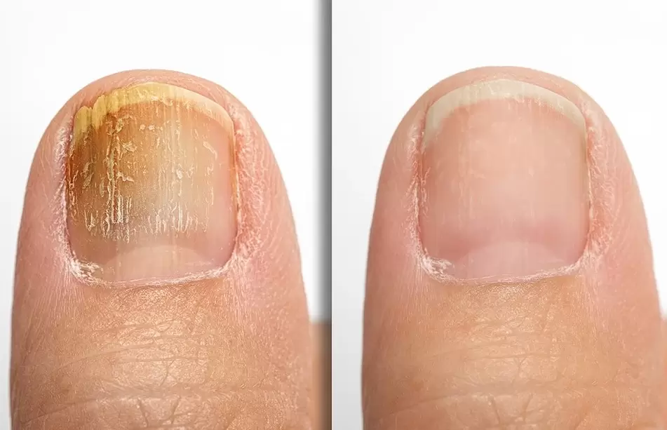 A nail showing signs of fungus (left) and a healthy nail (right)