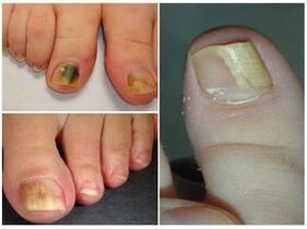 Appearance of toenails affected by onychomycosis