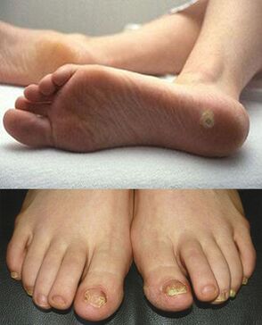 Manifestations of fungal infections on the skin and toenails
