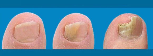 The development of onychomycosis - toenail fungus