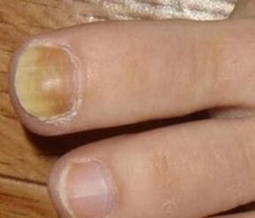 Symptoms of the initial step of the nail fungus